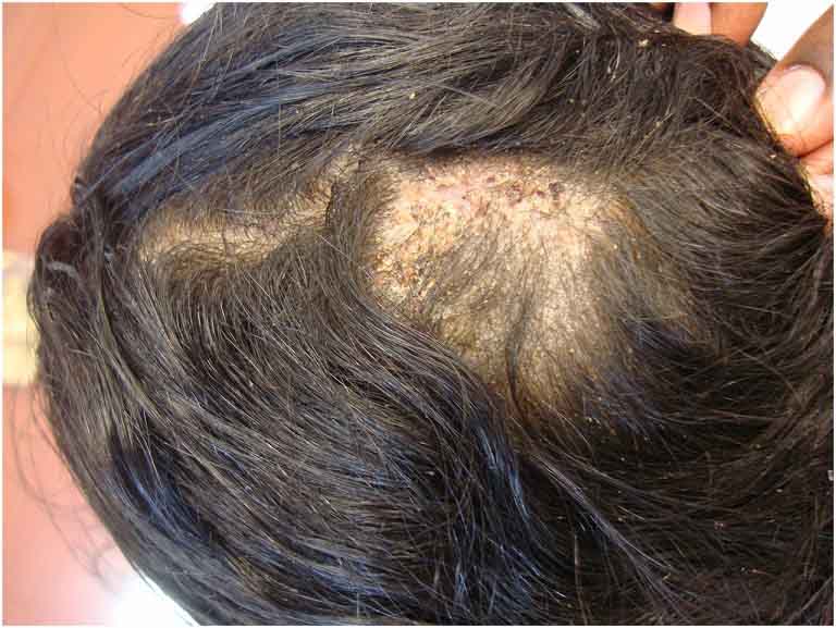 Nấm da đầu gây ngứa ngáy dữ dội, nguy cơ biến chứng cao