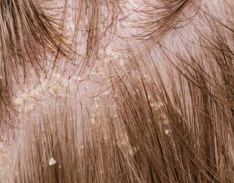Gàu da đầu gây cảm giác ngứa khó chịu, ảnh hưởng nghiêm trọng tới sinh hoạt hàng ngày