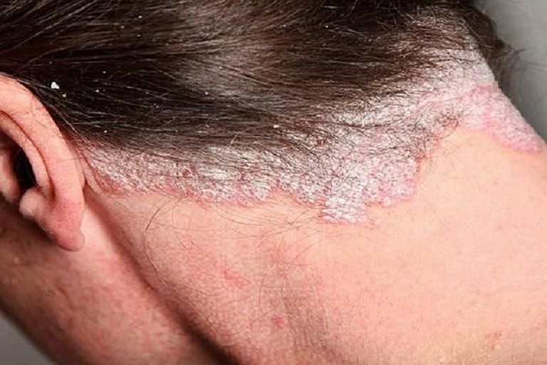Nấm da đầu có lây không là thắc mắc của hầu hết người bệnh