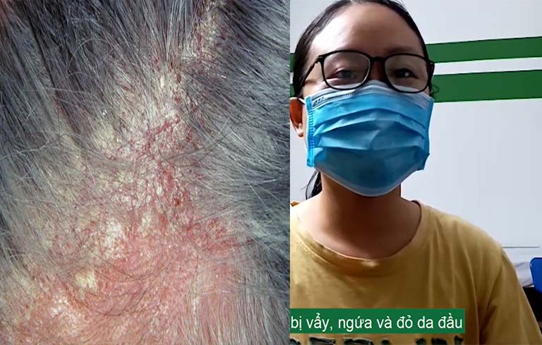 Tình trạng viêm da đầu của bé Trang khi đến với Trung tâm Thuốc dân tộc
