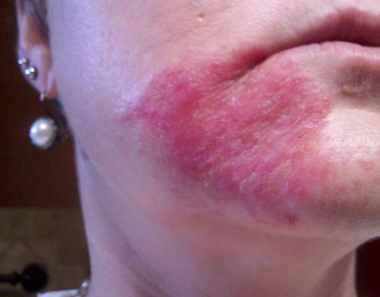 Vùng da quanh miệng có dấu hiệu sưng, tấy đỏ là biểu hiện rõ nhất của bệnh