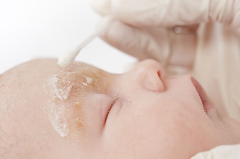 Trẻ sơ sinh bị bệnh thường xuất hiện những đốm màu cam trên da mặt kèm mảng vảy