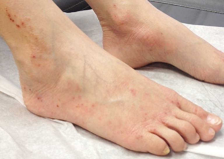 Người bệnh có thể bị hoại tử chân nếu bị nhiễm trùng máu