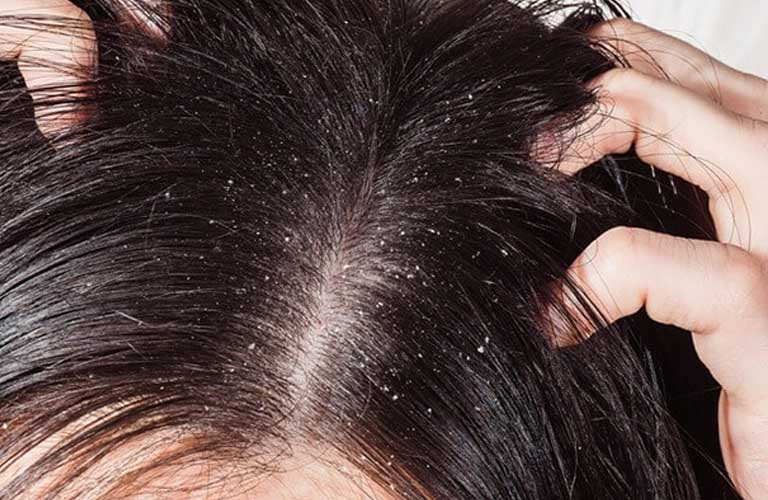 Viêm da đầu ảnh hưởng đến đời sống sinh hoạt của người khá lớn