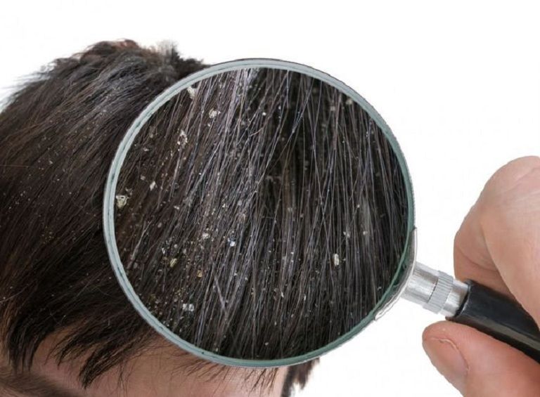 Người bệnh nấm da đầu cần chủ động thăm khám điều trị và chăm sóc phù hợp để tránh làm lây nhiễm
