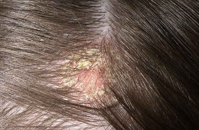 Bệnh nấm da đầu gây nhiều khó chịu ảnh hưởng đến sinh hoạt hàng ngày của người bệnh