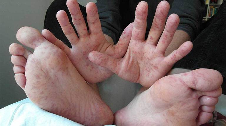 Viêm da cơ địa ở tay, chân: Cách điều trị và phòng ngừa tái phát