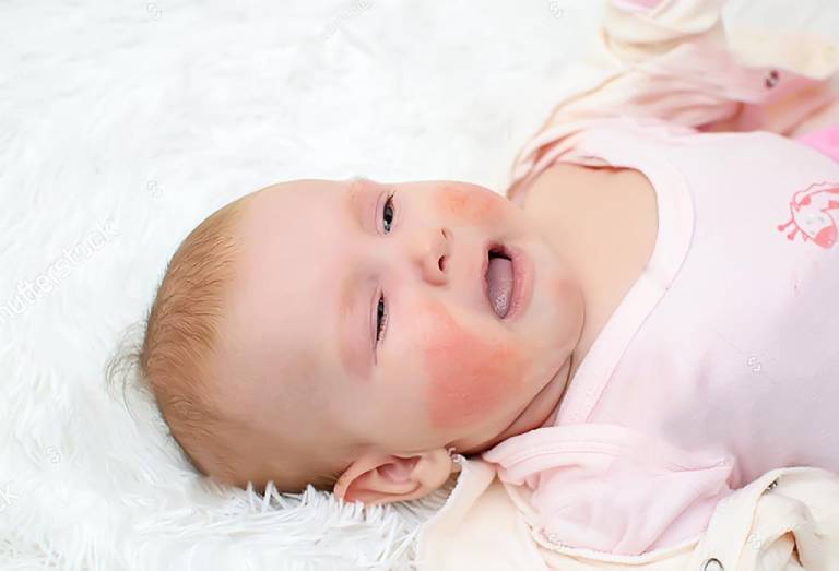 Viêm da cơ địa ở trẻ sơ sinh: Cách chăm sóc và điều trị hiệu quả